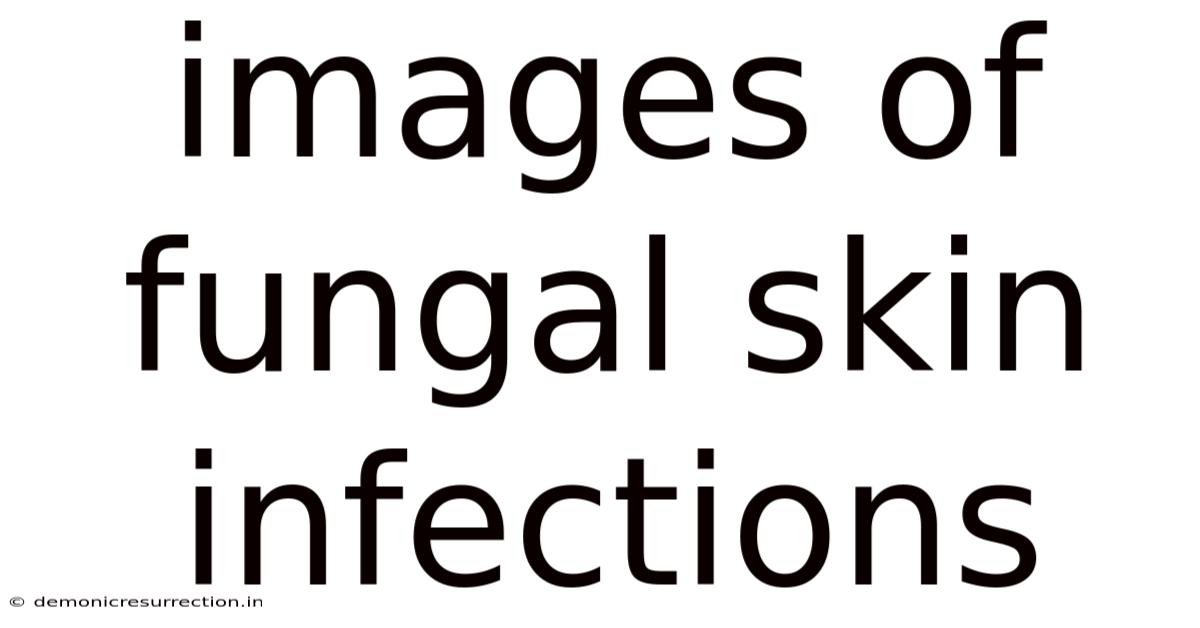 Images Of Fungal Skin Infections