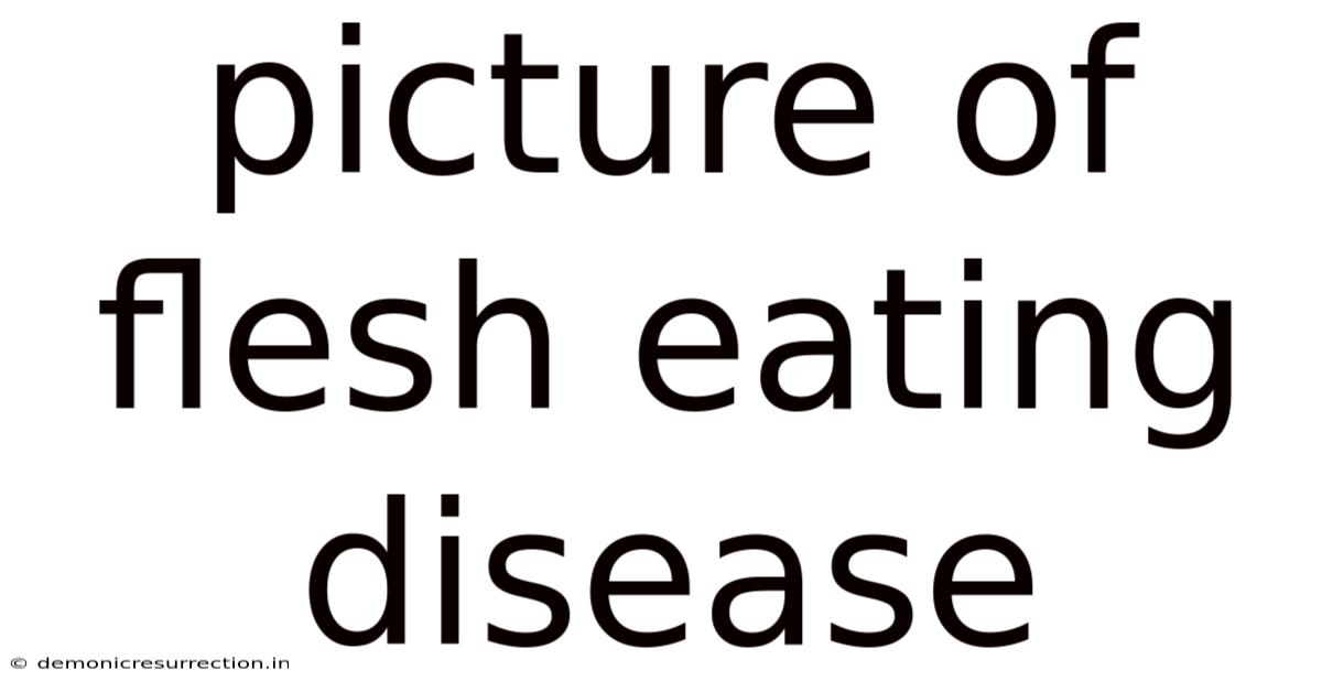 Picture Of Flesh Eating Disease